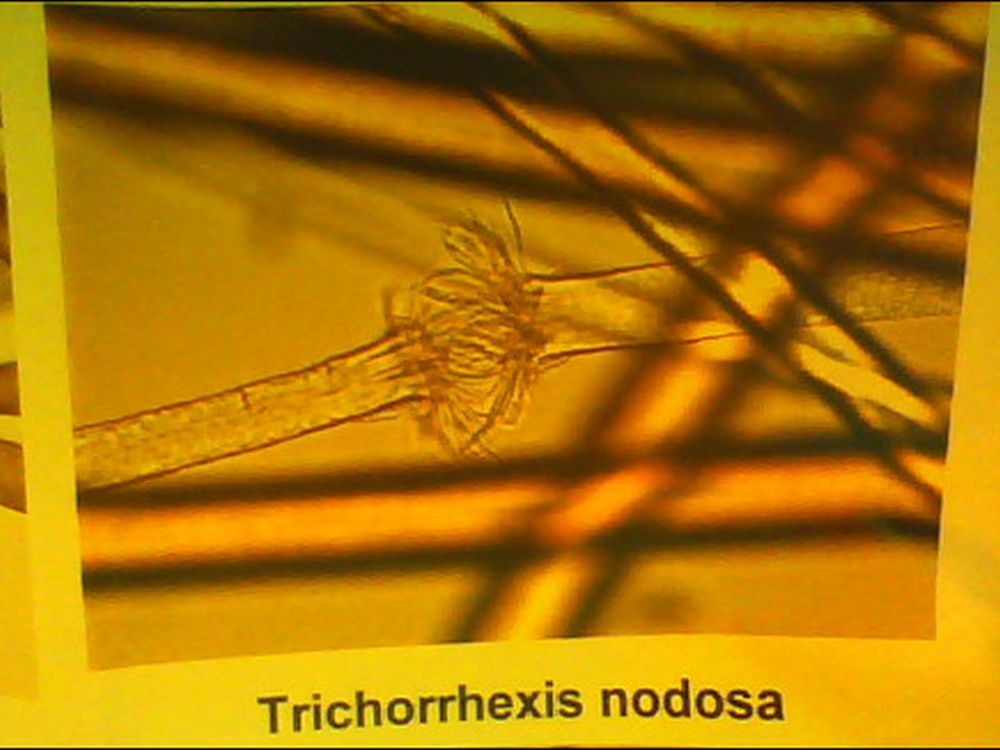 Trichorrhexis nodosa - Haare